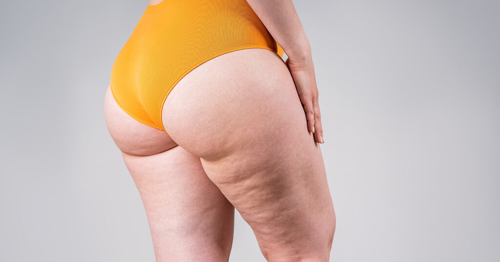 Big Thighs Associated With Lowered Risk of Stroke and Heart Attack - Featured image