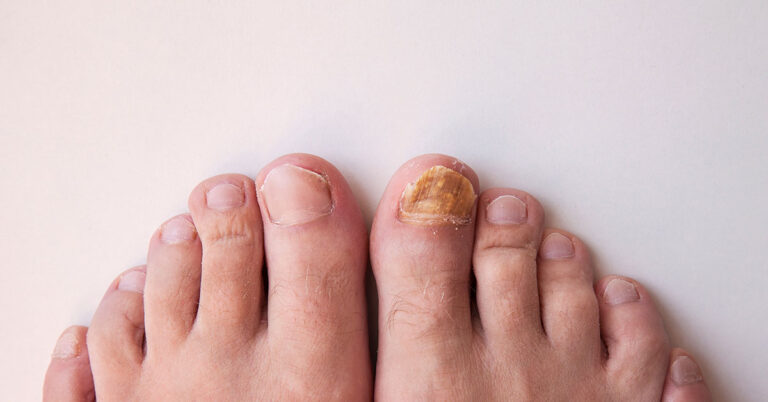 Is This Why You Have Thick Toenails And How To Get Rid Of Them - l7ckynj