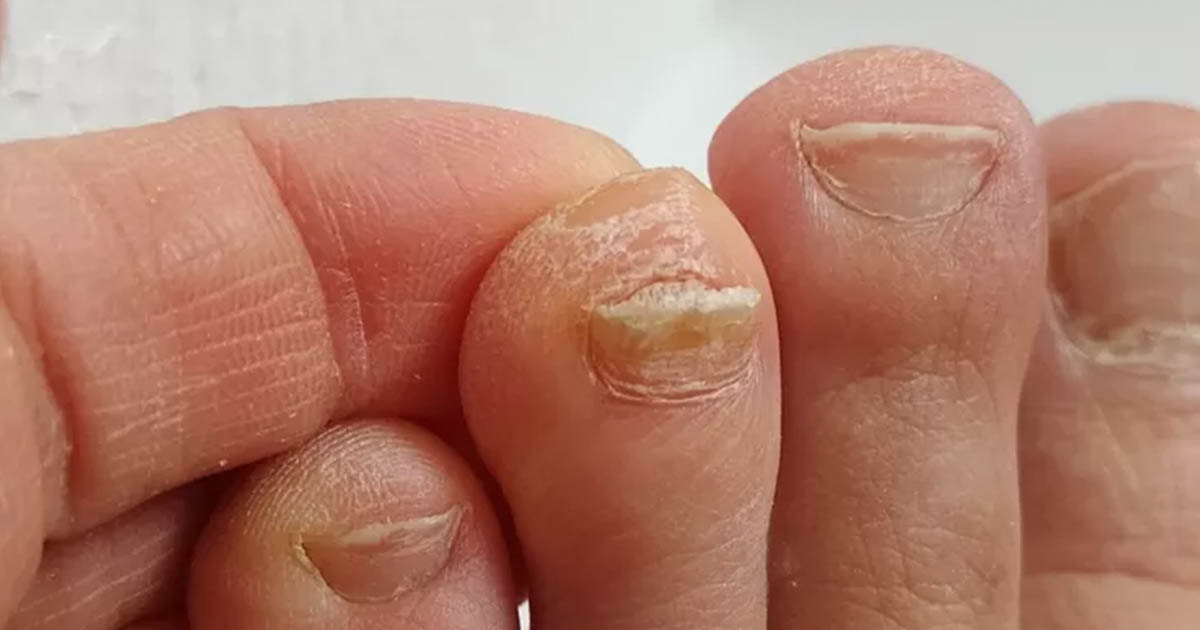 Thick Toenails: Treatment, Management, Causes, and More : The Hearty Soul