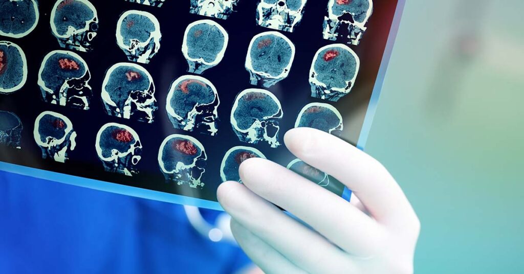 Brain Cancer Specialist Reveals Habits She Adopts To Cut The Risk Of The Disease - Featured image