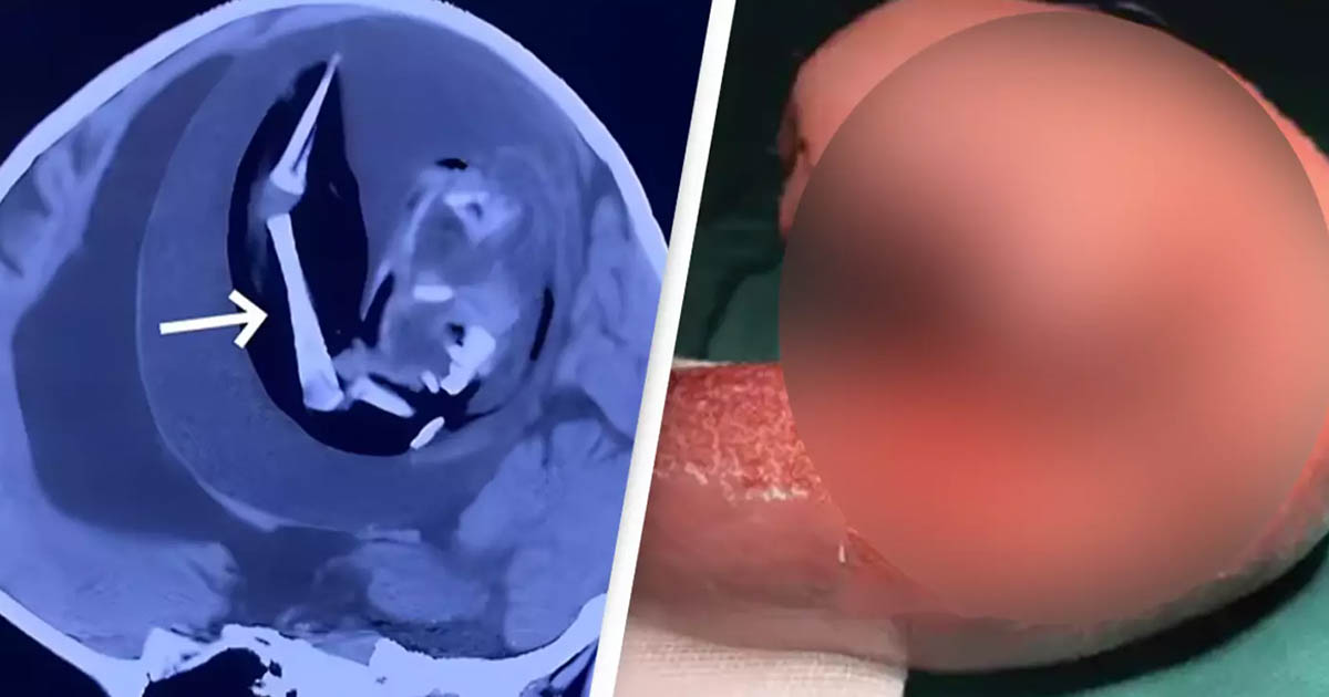 Doctors Shocked After Discovering Fetus Growing in Infant’s Skull : The Hearty Soul