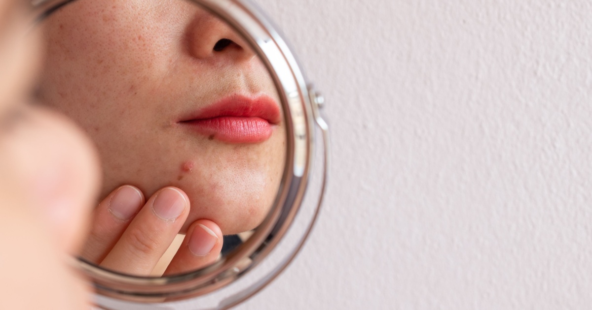 woman looking at a pimple on her face in the mirror