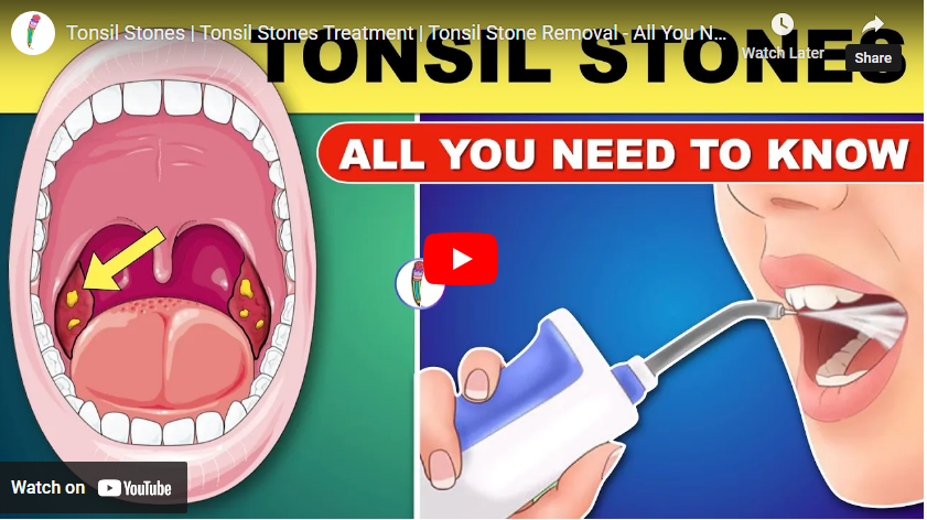 tonsil youtube video