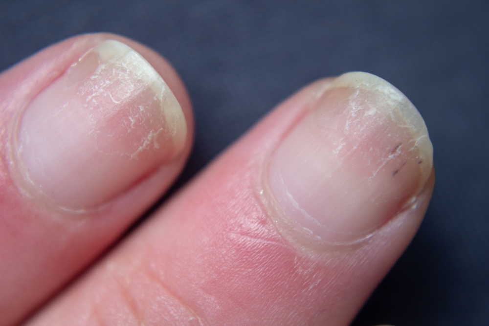 Dry nails . Damaged fingernails .
Chipped nails