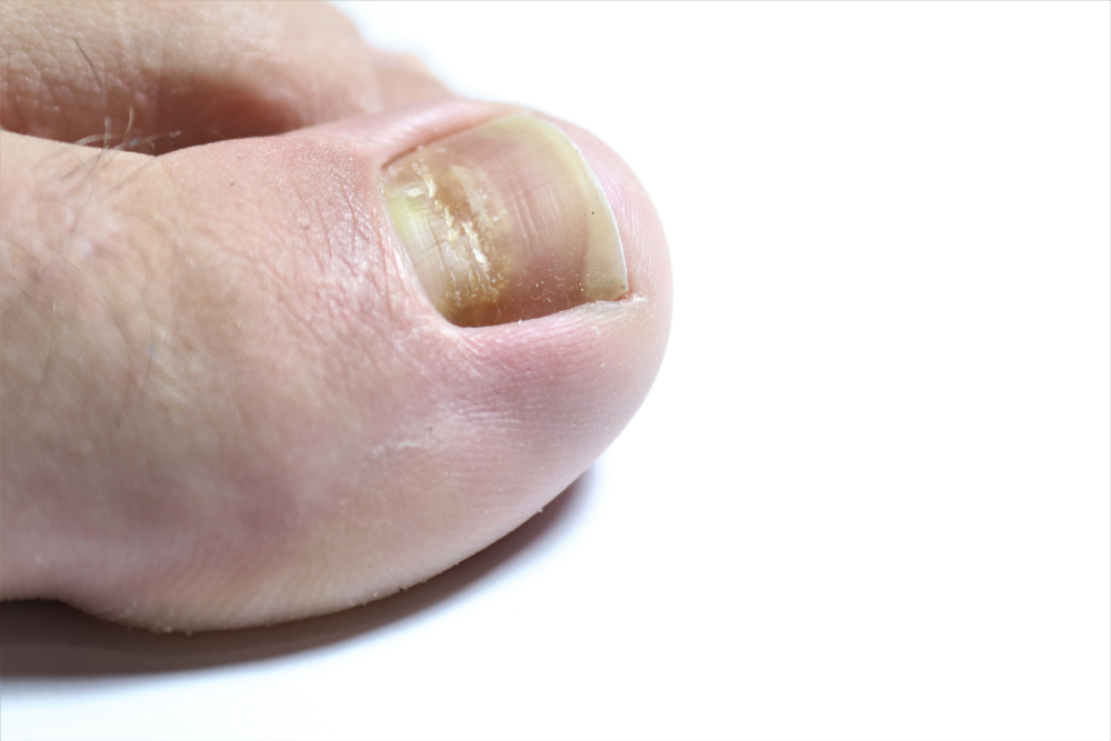Beau's lines are deep grooved lines that run from side to side on the fingernail or the toenail.They may look like indentations or ridges in the nail plate. May be caused by a lack of Zinc / Calcium.