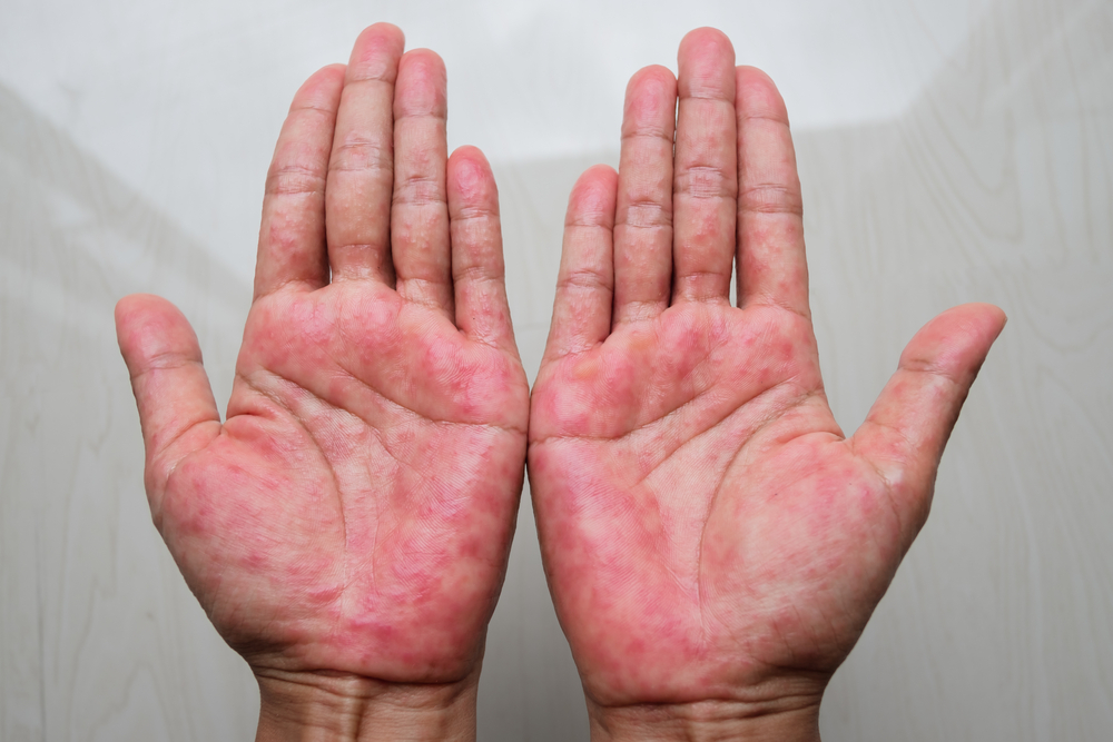Atopic dermatitis (AD), also known as atopic eczema, is a type of inflammation of the skin (dermatitis) at Hands