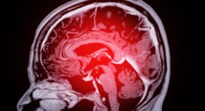 Warning Signs of Stroke You Might Be Missing - Know Every One Mri,Brain,Scan,For,Detect,Brain,Diseases,Sush,As,Stroke