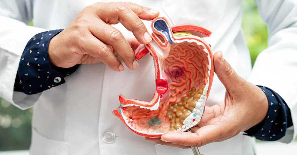 Stomach Cancer Often Develops Silently. Here Are 9 Early Symptoms to Look Out For - Featured image