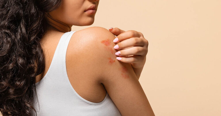 8 Kinds of Food Linked to Eczema Flare-Ups - Featured image