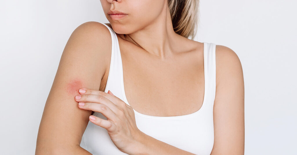 11 Ways to Treat and Stop Mosquito Bites from Itching - Featured image