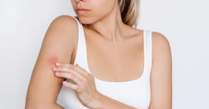 woman touching bug bite on arm. mosquito bite concept