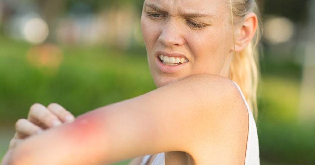How to Treat a Wasp Sting (And When To Seek Medical Attention) - Featured image