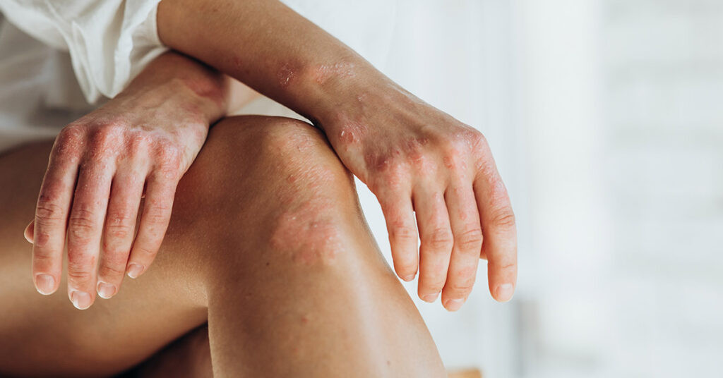 10 Home Remedies for Psoriasis You Can Try Yourself - Featured image
