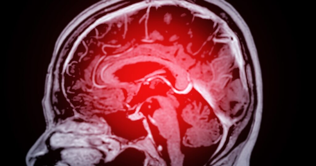 Surprising New Research Reveals What’s Really Raising Your Dementia Risk - Featured image
