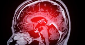 Surprising New Research Reveals What's Really Raising Your Dementia Risk dementia