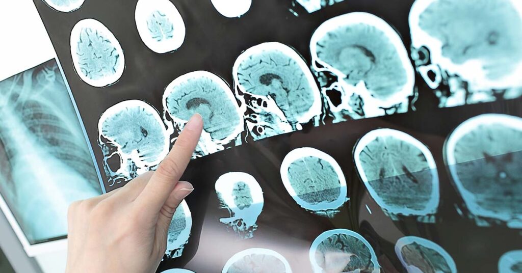 10 Unmistakable Signs Your Body Might Be Sounding the Ischemic Stroke Alarm - Featured image