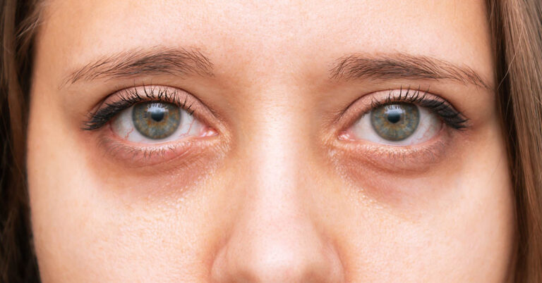 8 Reasons For Dark Circles Under The Eyes That Have Nothing to Do With Lack of Sleep - Featured image