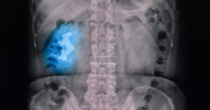 What Are Staghorn Kidney Stones? (Symptoms, Causes, and Treatment) A xray film of a patient with large staghorn stone in his right kidney.