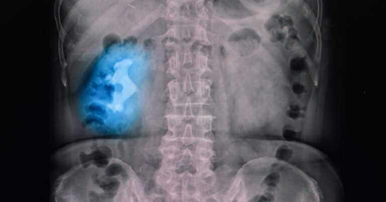 What Are Staghorn Kidney Stones? (Symptoms, Causes, and Treatment)  - Featured image