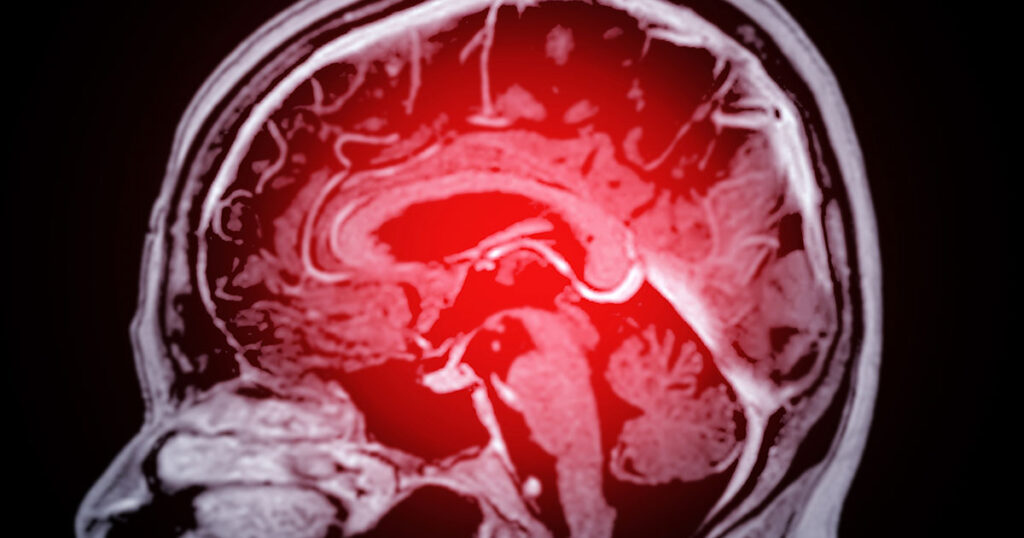 14 Steps To Help Prevent 50 Million Cases of Dementia By 2050 - Featured image