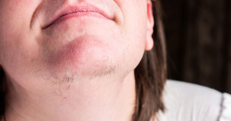 What Causes Excessive Dark Facial and Body Hair Growth in Women? - Featured image