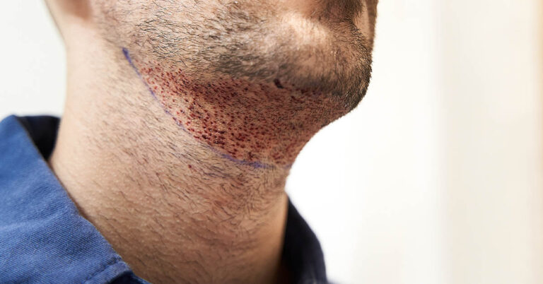 Student took own life after ‘estate agent pretending to be a surgeon’ gave him a beard transplant in Turkey - Featured image