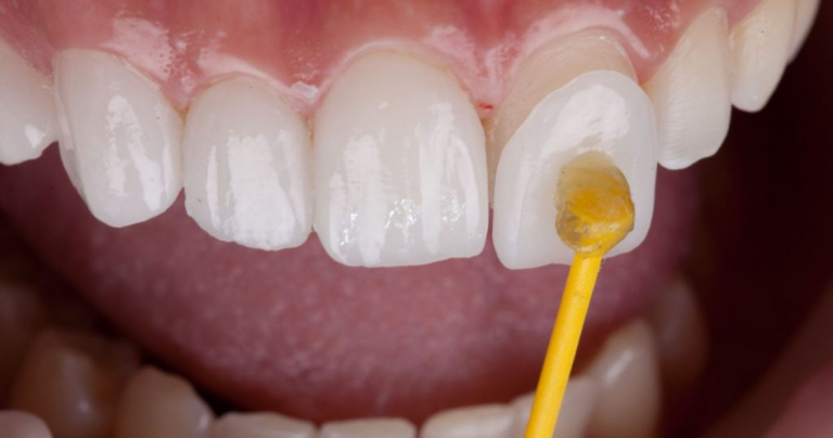 Our ‘Turkey teeth’ cost us $4,800 and look lovely but they’ve ruined our lives’ - Featured image