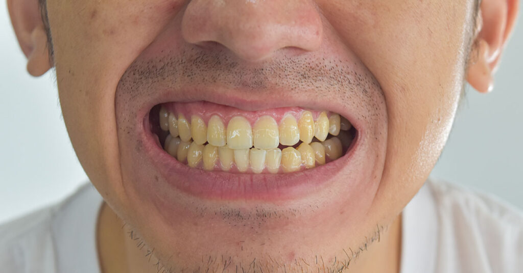 This Popular Drink Could Be Permanently Staining Your Teeth Yellow, Expert Say - Featured image