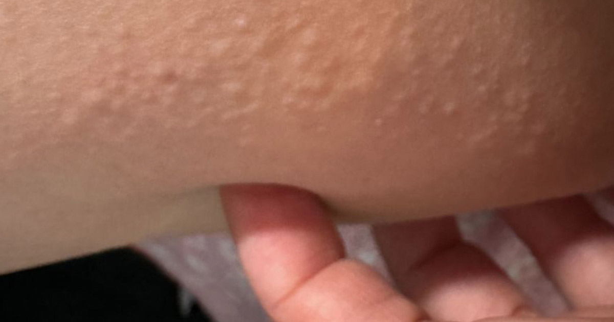 Reasons For Raised Bumps On Your Skin