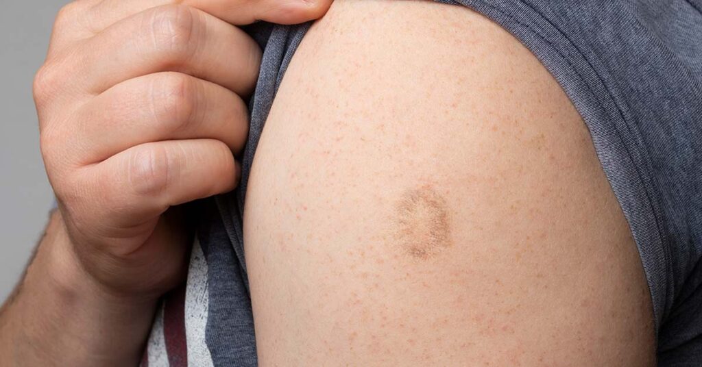 Why You Have a Smallpox Vaccine Scar and What it Means - Featured image