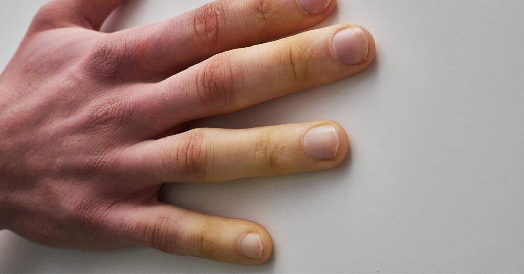 Cold Hands Were a Red Flag: Man Shares Shocking Diagnosis After Two-Year Prognosis - Featured image