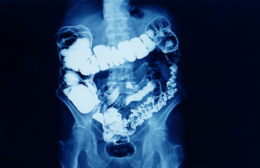 barium enema x-ray showing contrast fill in most part of large intestine such as transverse colon, sigmoid colon and rectum. the patient has colon cancer. medical film on dark background
