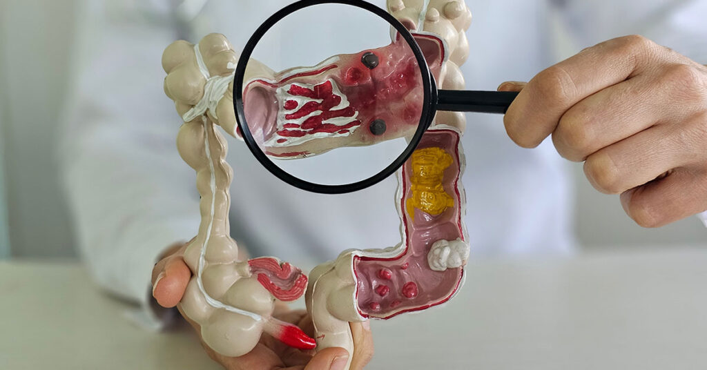 Colorectal Cancer Specialist Reveals 5 Things They’d Never Do - Featured image