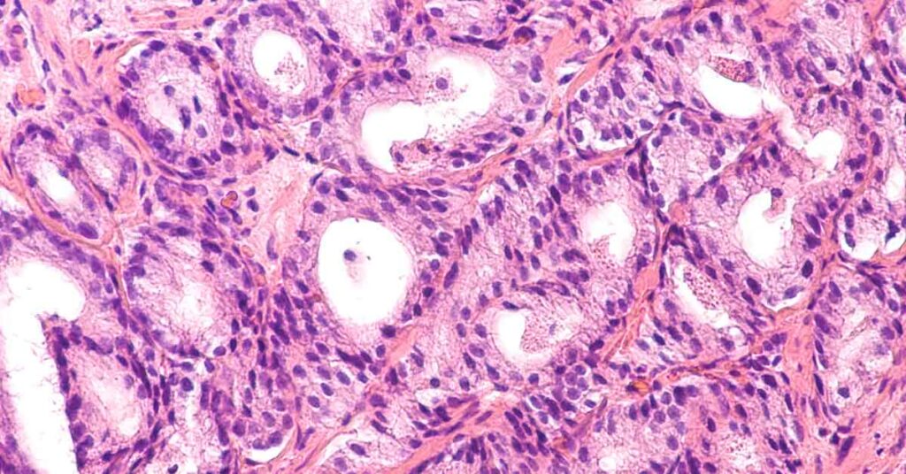 Is Cancer Reversible? New Treatment May Transform Cancer Cells into Healthy Ones - Featured image