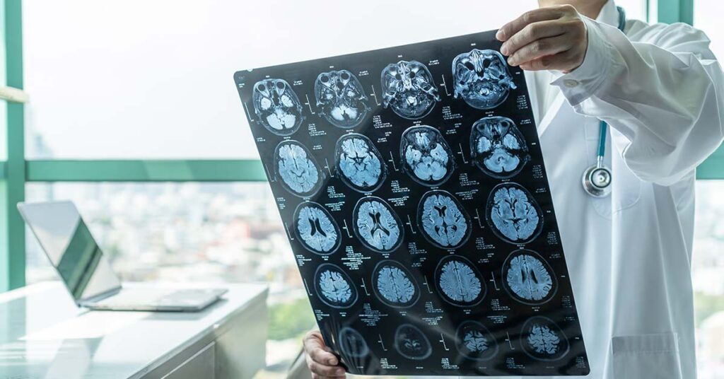 Virus Most People Encounter May Play a Role in Developing Alzheimer’s, Study Suggests - Featured image