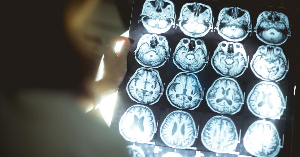 The Surprising Link Between Dreams and Dementia or Parkinson’s Disease - Featured image