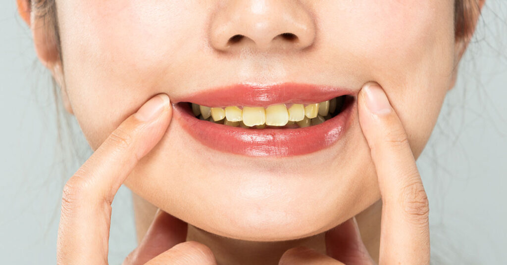 Why Your Teeth Are Yellow Even Though You Brush Them: Dentist - Featured image