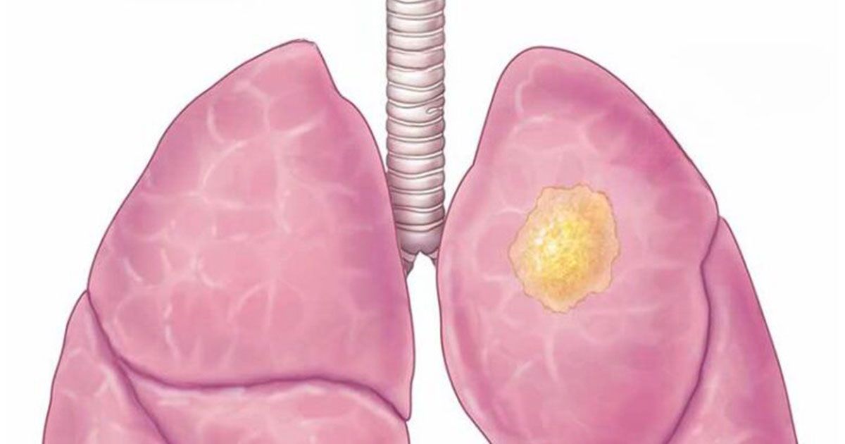 34 Year Old Woman With Terminal Cancer Reveals 5 Warning Signs She