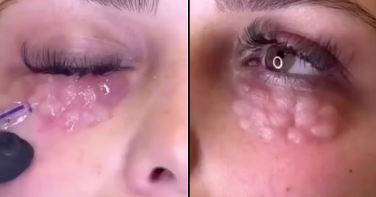 Picture of Doctor Issues Warning About Cosmetic Fad Causing 'Reptile-Like' Skin ...