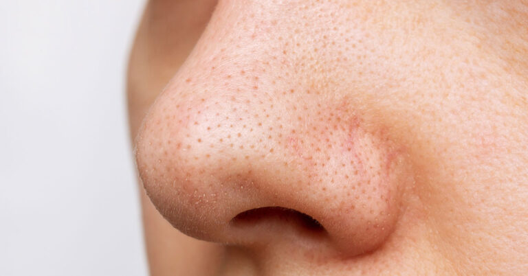 What Are Sebaceous Filaments and Why Are They on Your Face? - Featured image