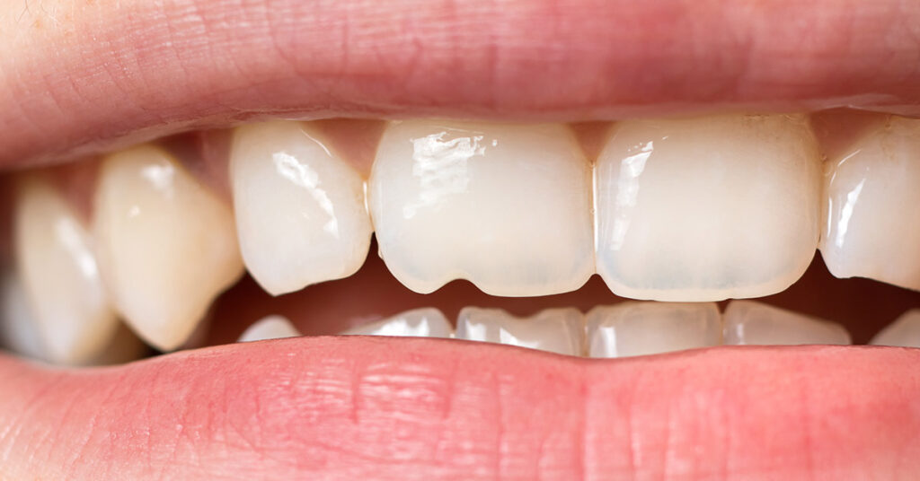 Regrowing Teeth Is on the Horizon and May Represent the Future of Dentistry - Featured image