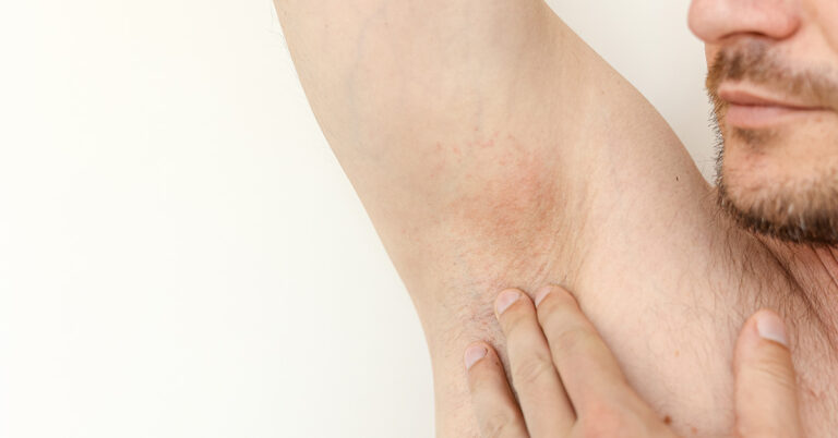 The Common Habits That Can Cause Bumps Under The Arms & What to Do - Featured image
