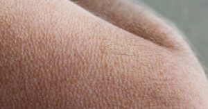 You Might Have a Special Brain If You Get Goosebumps When You’re Listening to Music Goosebumps on a person's arm