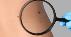 magnifying glass being placed over moles on skin. Signs of skin cancer concept