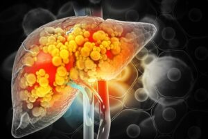 Liver,Damage,Such,As,Fatty,Liver,,Fibrosis,,Cirrhosis,,And,Liver