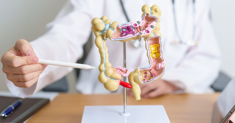 10 Natural Remedies to Cleanse and Support Colon Health - Featured image