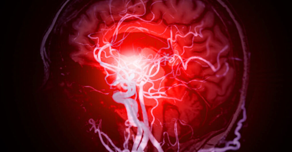 12 Early Warning Signs of an Aneurysm You Shouldn’t Ignore - Featured image