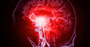 12 Early Warning Signs of an Aneurysm You Shouldn’t Ignore