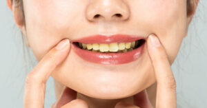 Dentist Reveals Two Common Brushing Mistakes That Can Cause Yellow Teeth woman with yellow teeth