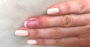 Guide to Paronychia: Exploring Its Causes, Recognizing the Symptoms, and Getting a Proper Diagnosis finger displaying symptoms of Paronychia